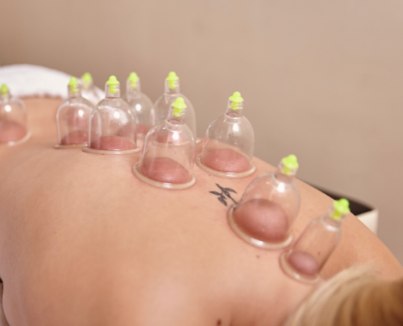 cupping