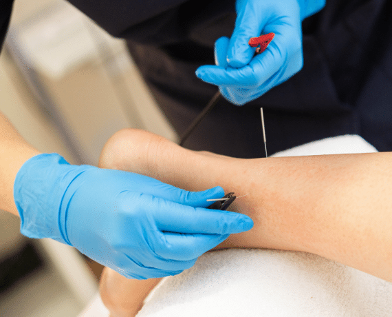 dry-needling